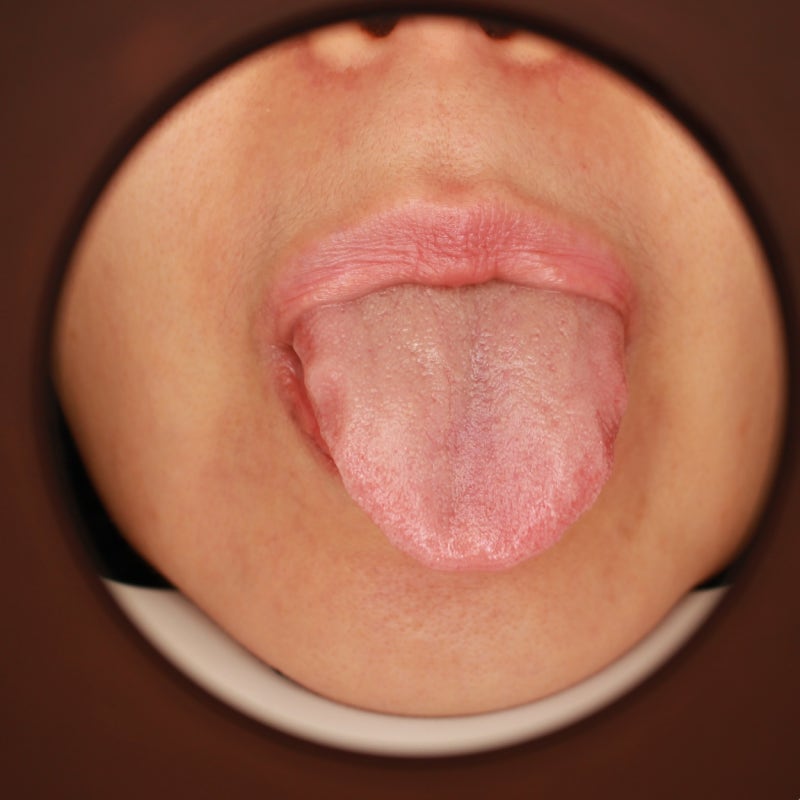 혀측면 통증 치흔설