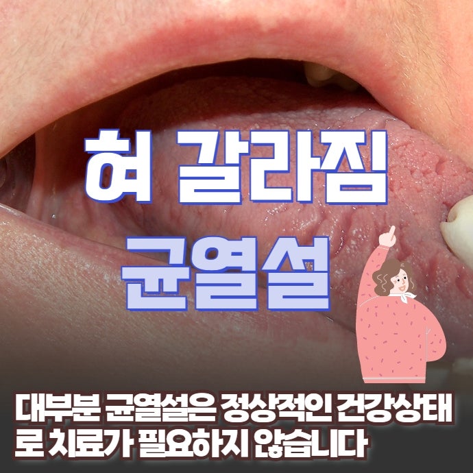 혀 갈라짐 균열설