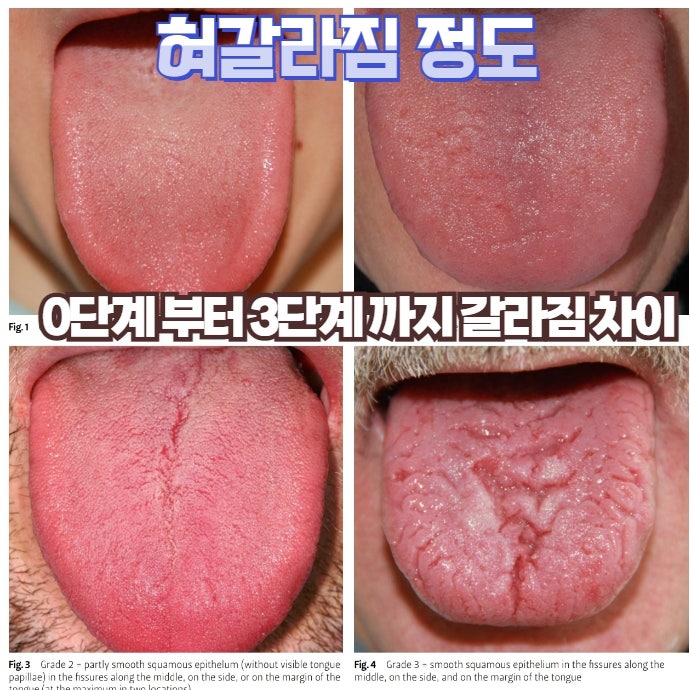 균열설 관련 질환