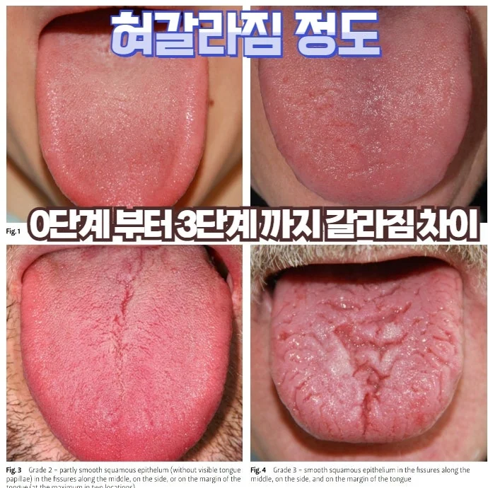 균열설 관련 질환