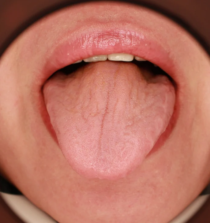 혀 따가움 혀 화끈거림 혀 갈라짐의 원인과 구강작열감증후군 감별법 - img 03