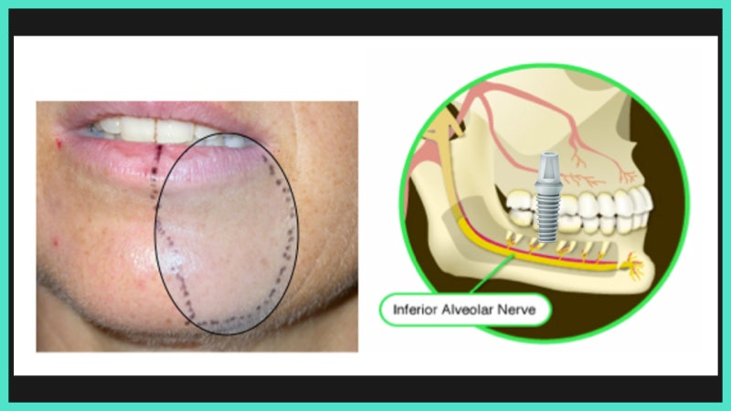 임플란트 신경 손상