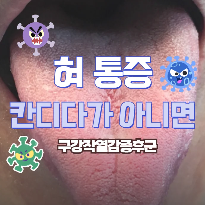 칸디다와 혀 통증