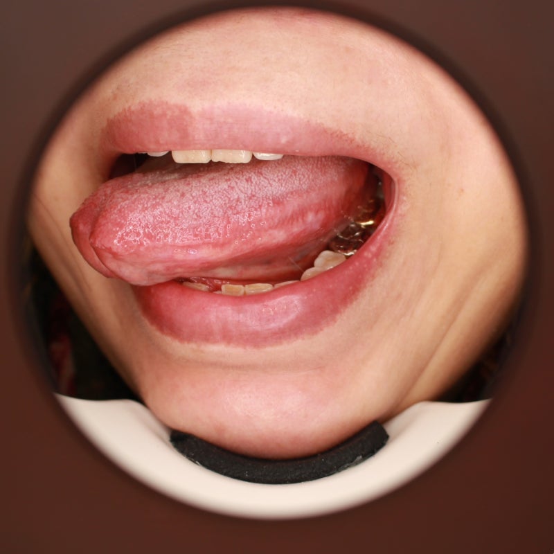 혀 옆 화끈거림