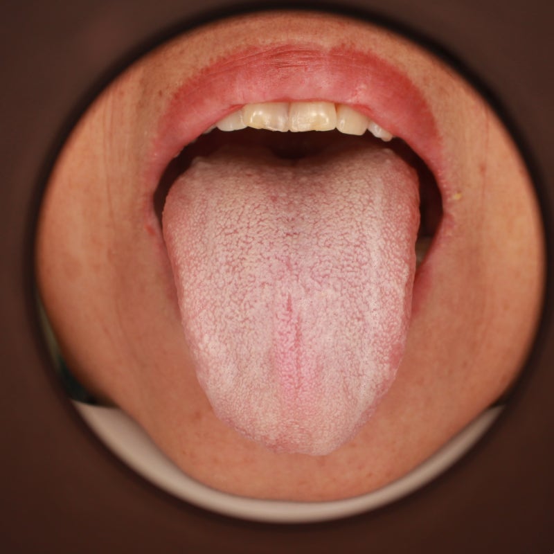 입천장 통증, 삼차신경통과 구강작열감 증후군의 차이점