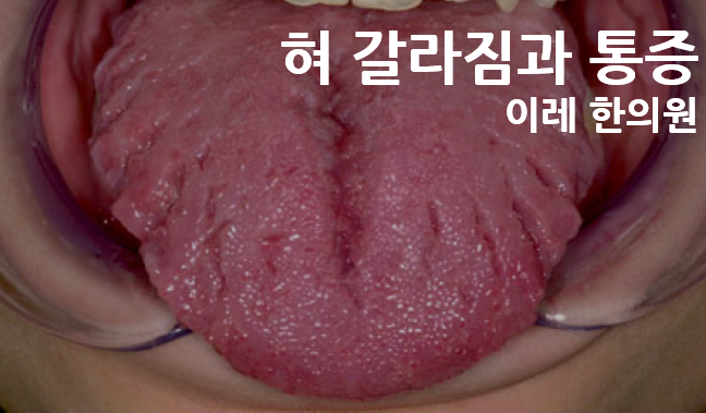 혀 갈라짐 - 혀 통증과 관련이 없을 수도 있습니다. 인천 이레 한의원