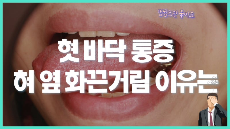 혀 바닥 통증과 화끈거림이 껌 씹을 때 줄어드는 이유 - BMS 감별 포인트