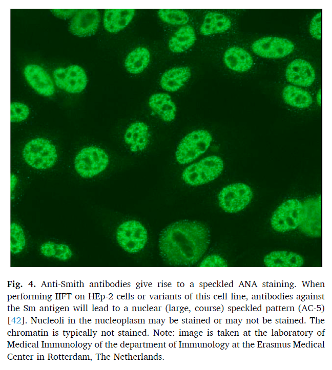 자가면역질환과 항-Sm 항체