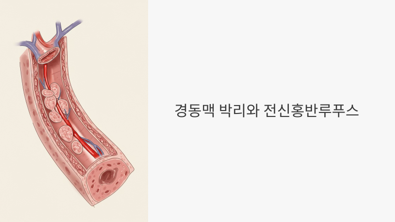 루푸스 환자에서 경동맥 박리 위험이 높아지는 이유