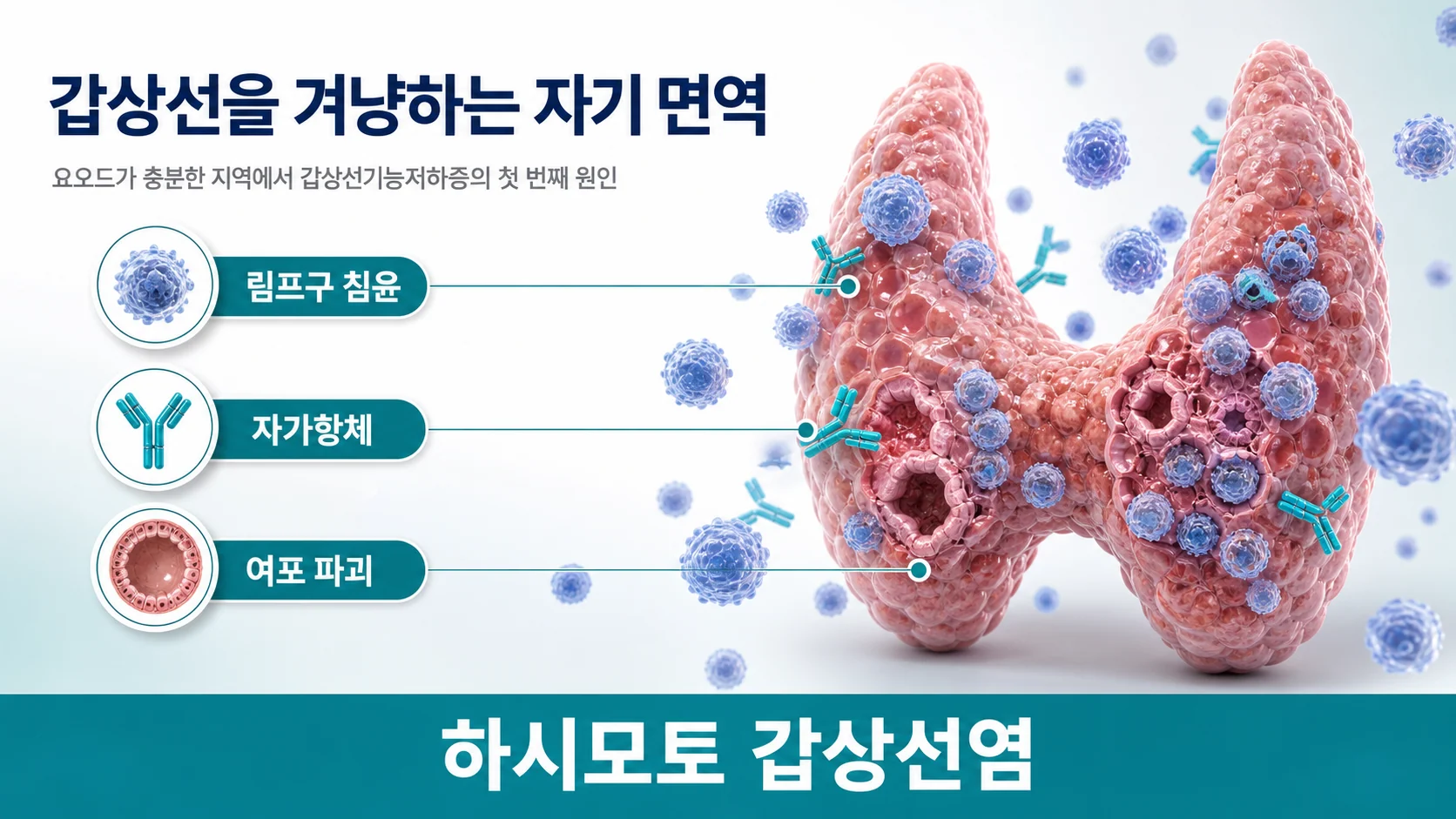하시모토 갑상선염에서 갑상선을 겨냥한 자가면역 반응 개념도