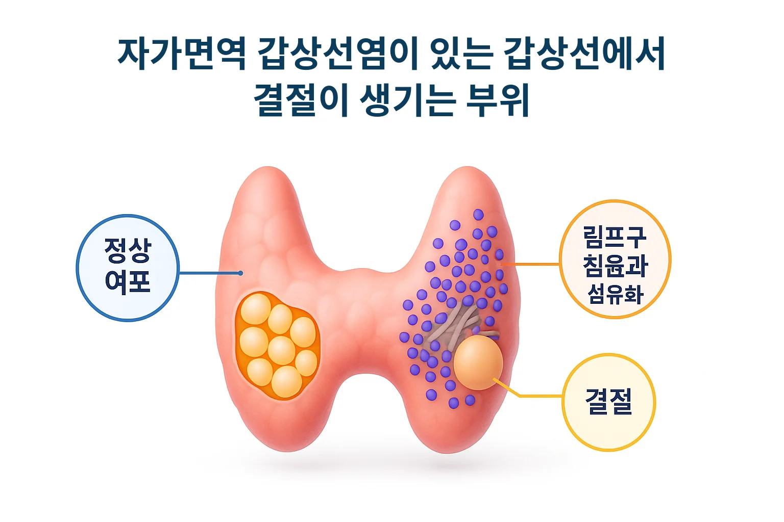 자가면역 갑상선염이 있는 갑상선의 정상 여포와 림프구 침윤·섬유화 부위, 결절이 생기는 부위를 나타낸 모식도