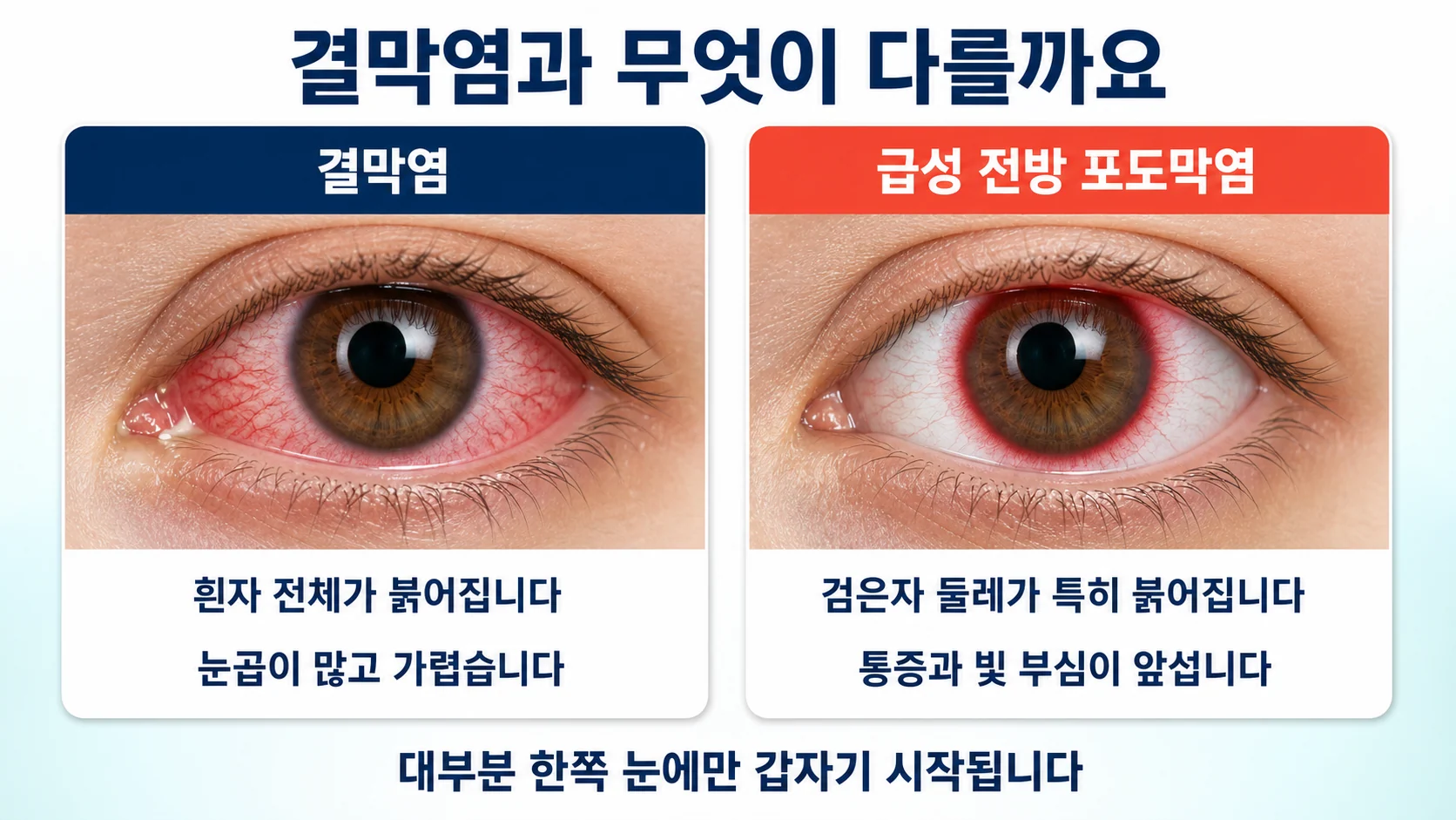 결막염과 무엇이 다른가 — 급성 전방 포도막염의 특징