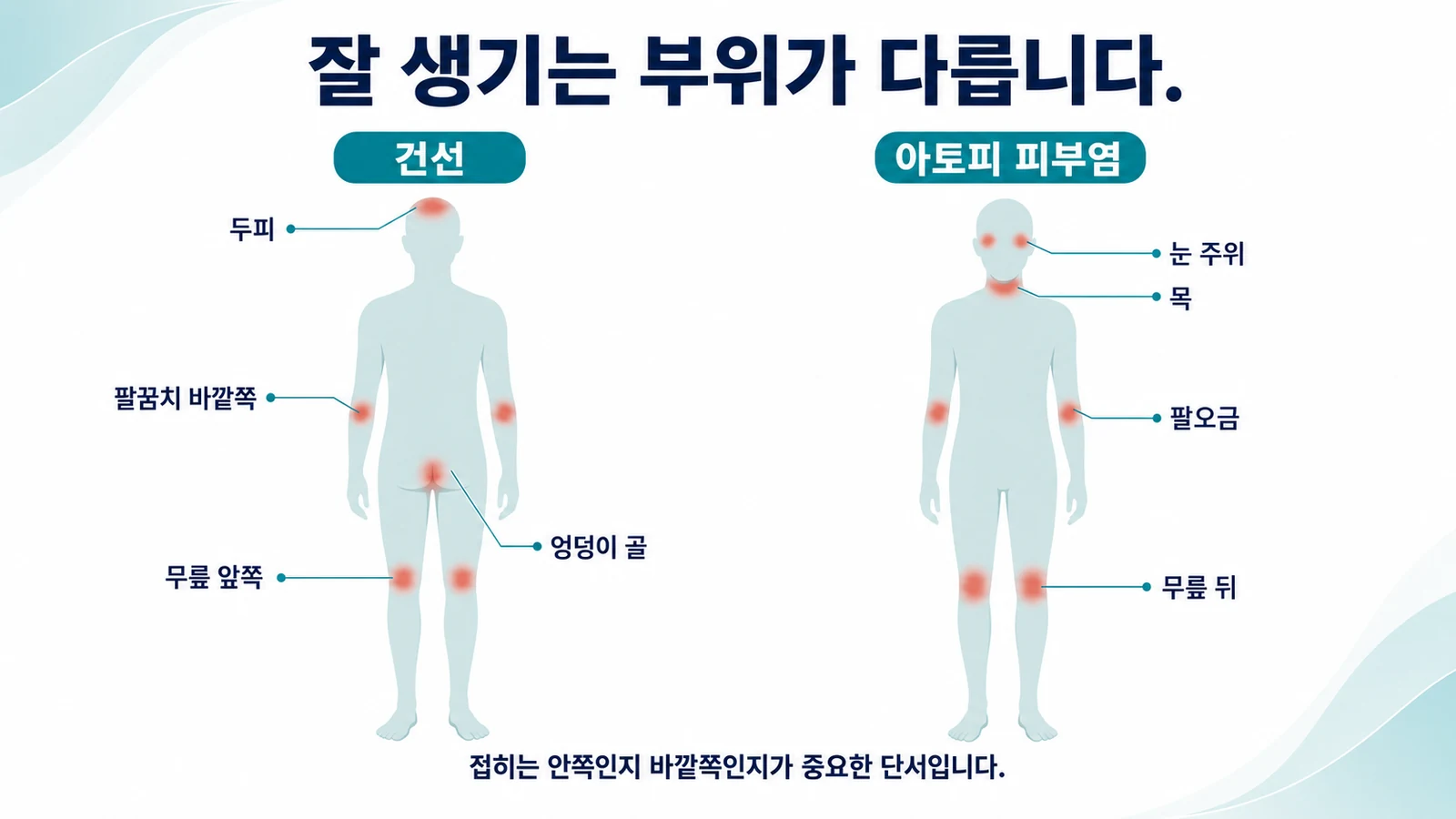 호발 부위 비교 — 신전측과 굴측