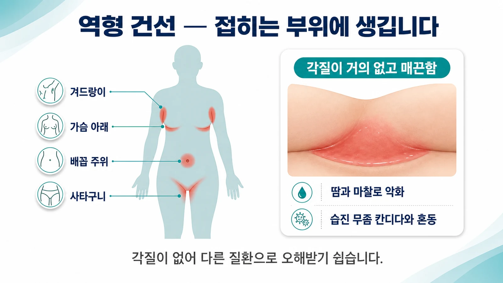 역형 건선이 생기는 자리와 겉모습