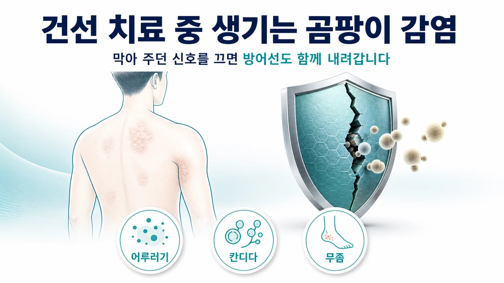 건선 치료 중 나타나는 곰팡이 감염의 배경을 설명하는 대표 이미지