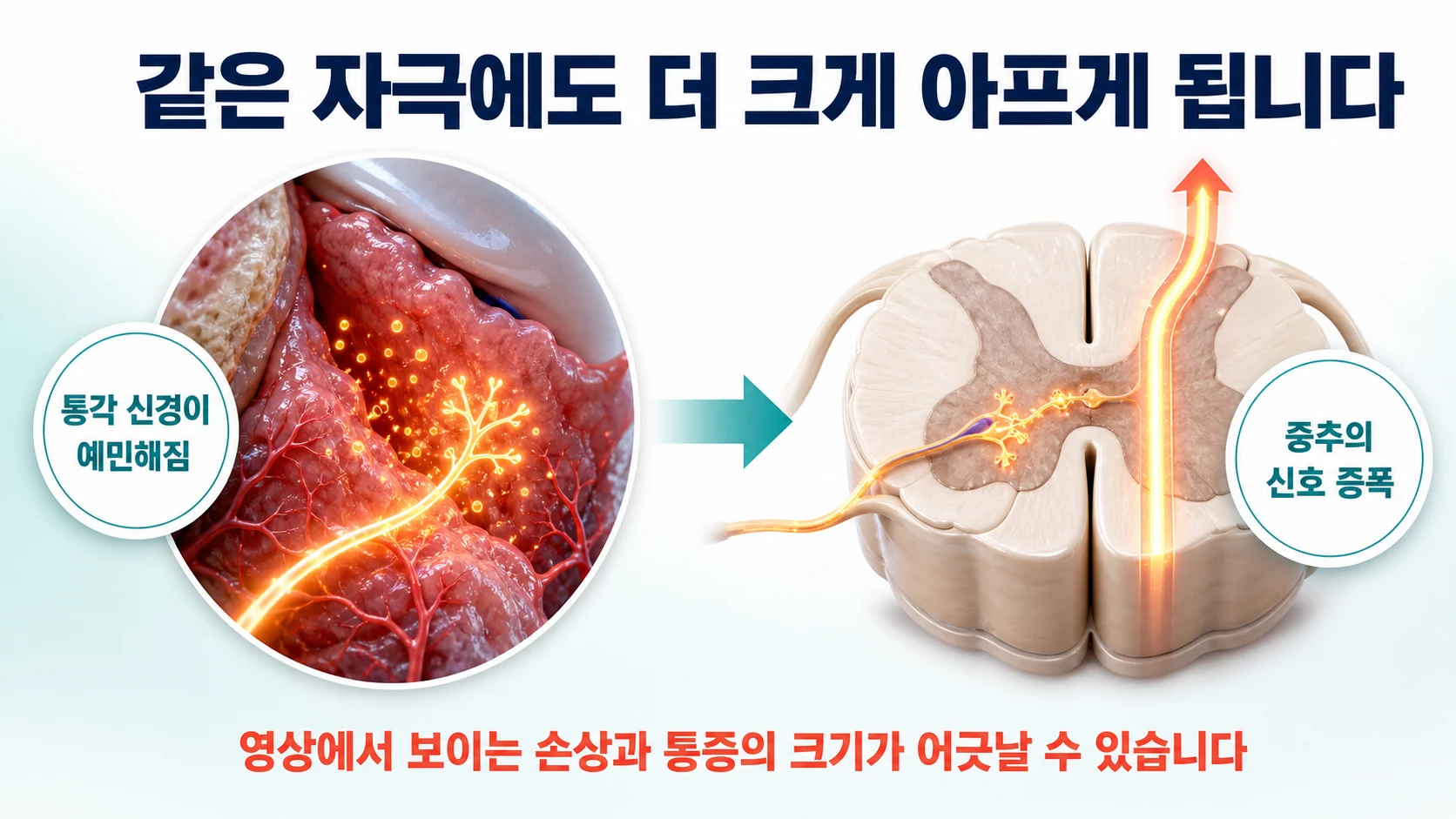 관절의 염증 물질이 통각 신경을 예민하게 만들어 손상 정도와 통증이 어긋나게 되는 과정을 나타낸 그림