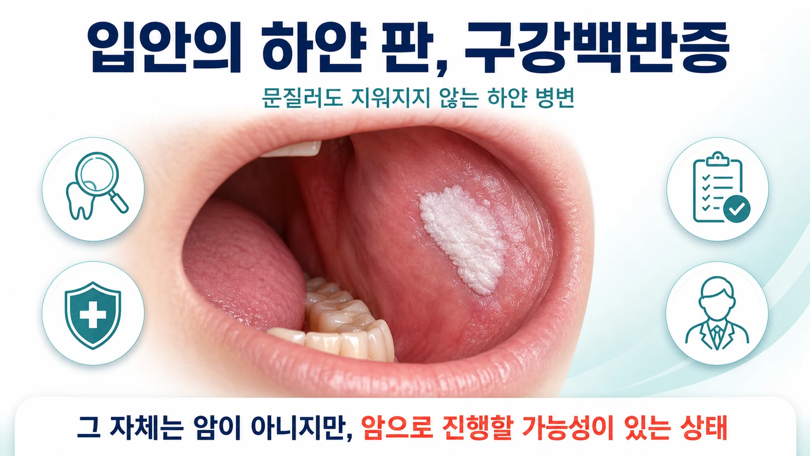 입안 점막에 생긴 하얀 판을 확대해 보여주며 전암 병변의 개념을 설명하는 의료 인포그래픽