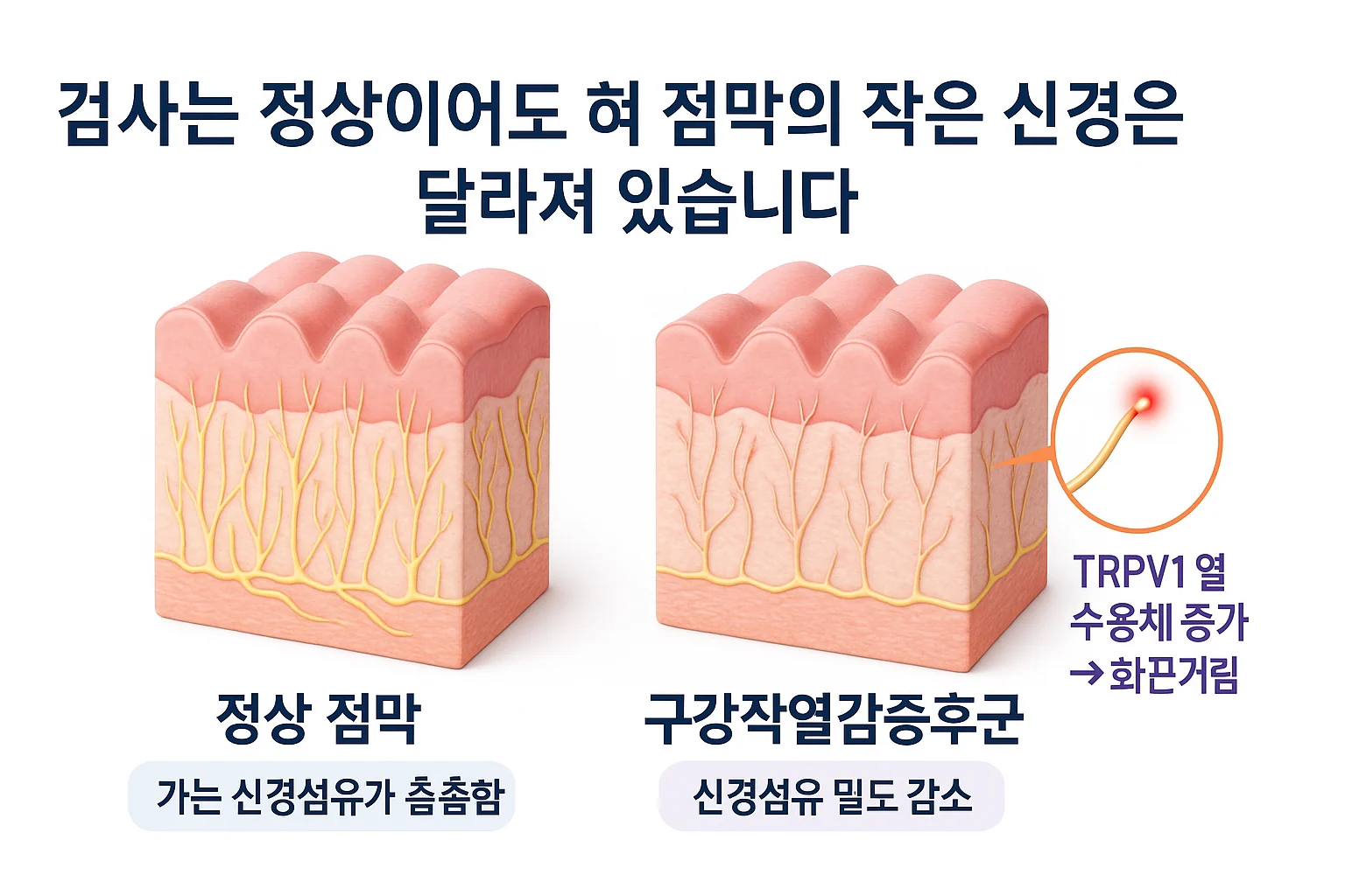 정상 혀 점막과 구강작열감증후군 혀 점막의 신경섬유 밀도를 비교한 단면 모식도