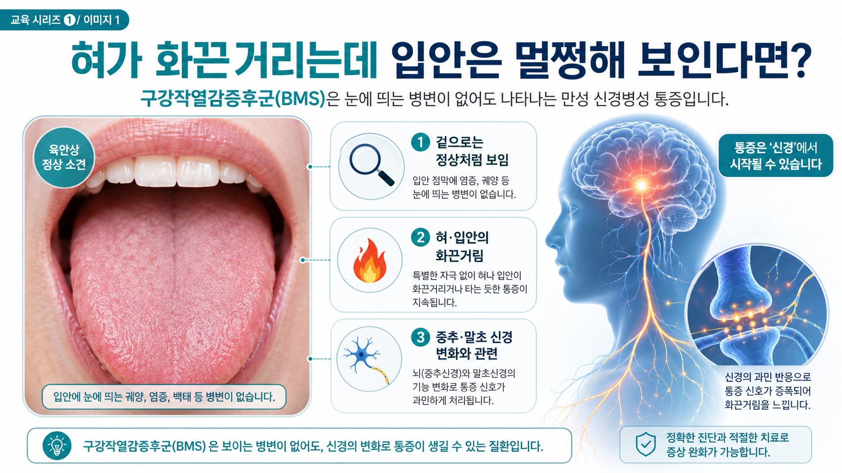 구강작열감증후군(BMS) 개요 — 혀가 화끈거리는데 입안은 정상으로 보이는 만성 신경병성 통증