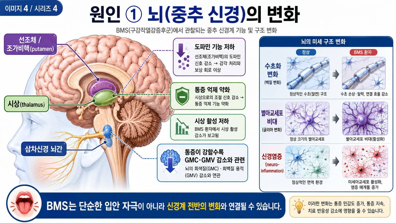 BMS 원인 ① 뇌(중추 신경)의 변화 — 도파민·회백질·신경염증