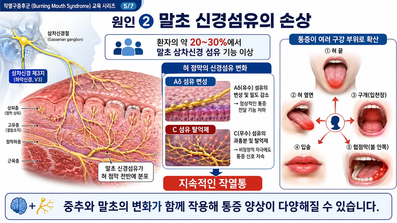 BMS 원인 ② 말초 신경섬유의 손상 — Aδ·C 섬유 변화