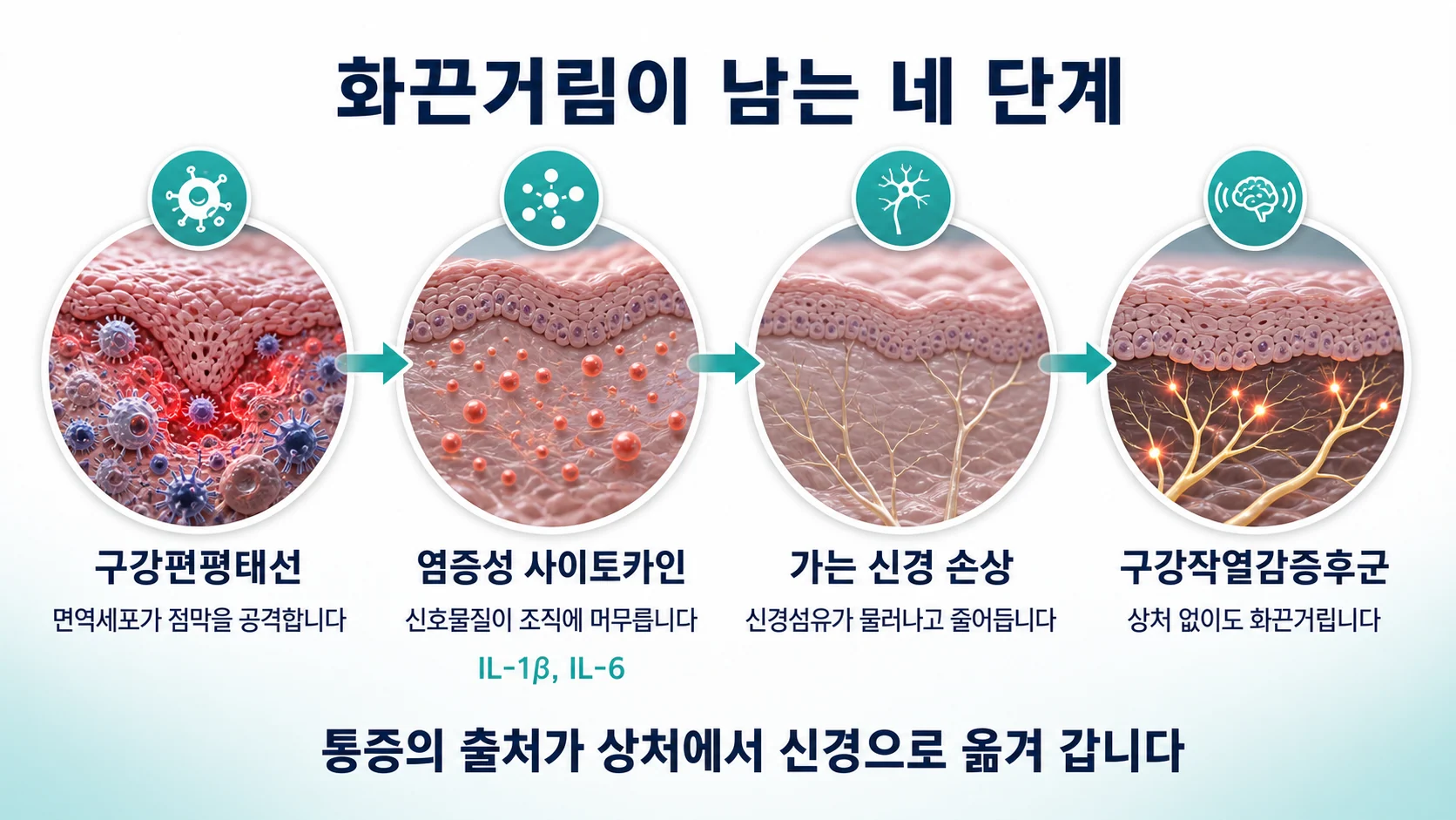 구강편평태선에서 시작해 염증성 사이토카인과 소섬유신경병증을 거쳐 구강작열감증후군으로 이어지는 네 단계 경로를 보여주는 그림