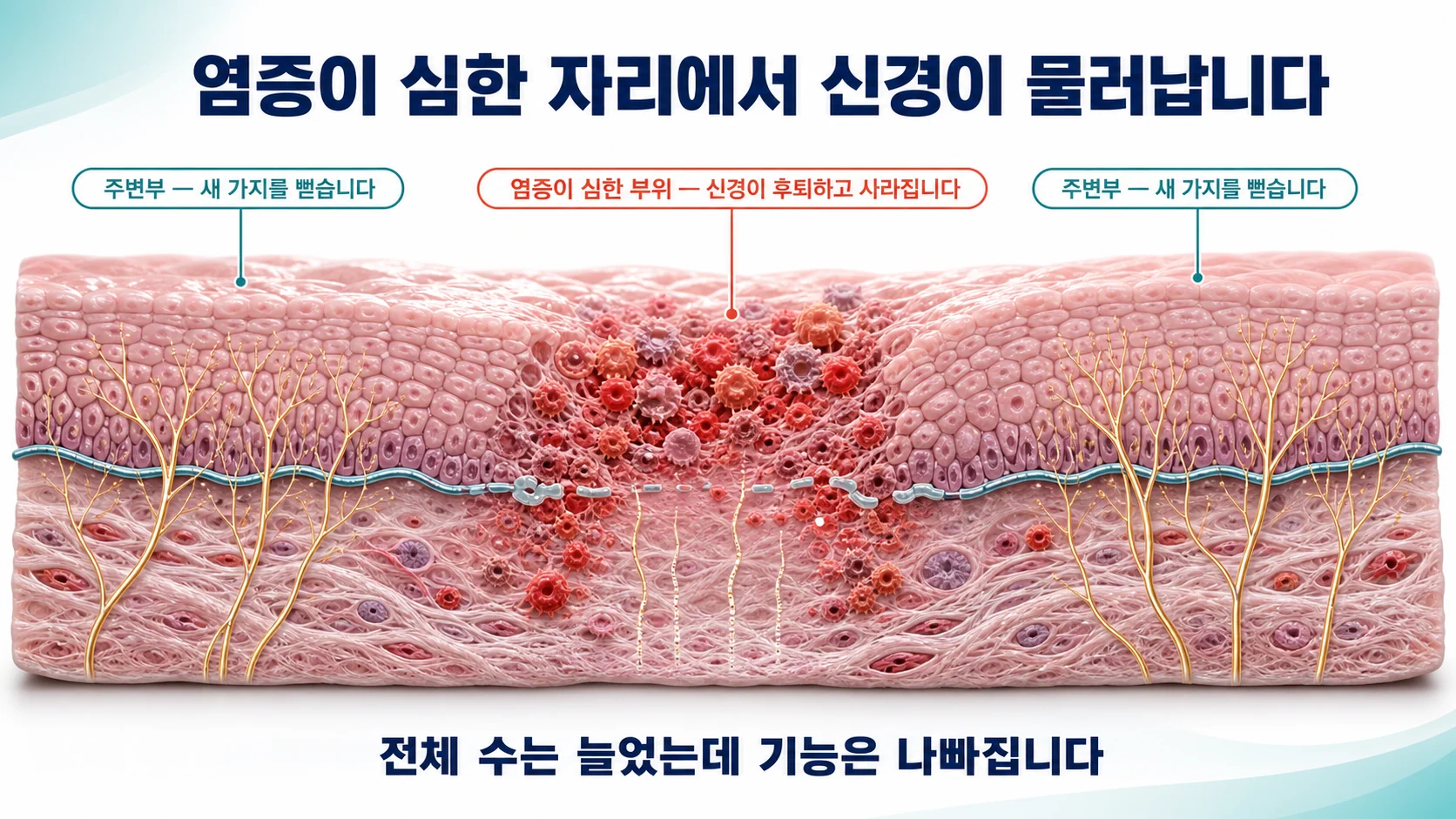 구강편평태선 병변에서 염증이 심한 부위의 신경섬유가 후퇴하고 사라지는 모습과 주변부에서 새 가지를 뻗는 발아 현상을 함께 보여주는 그림