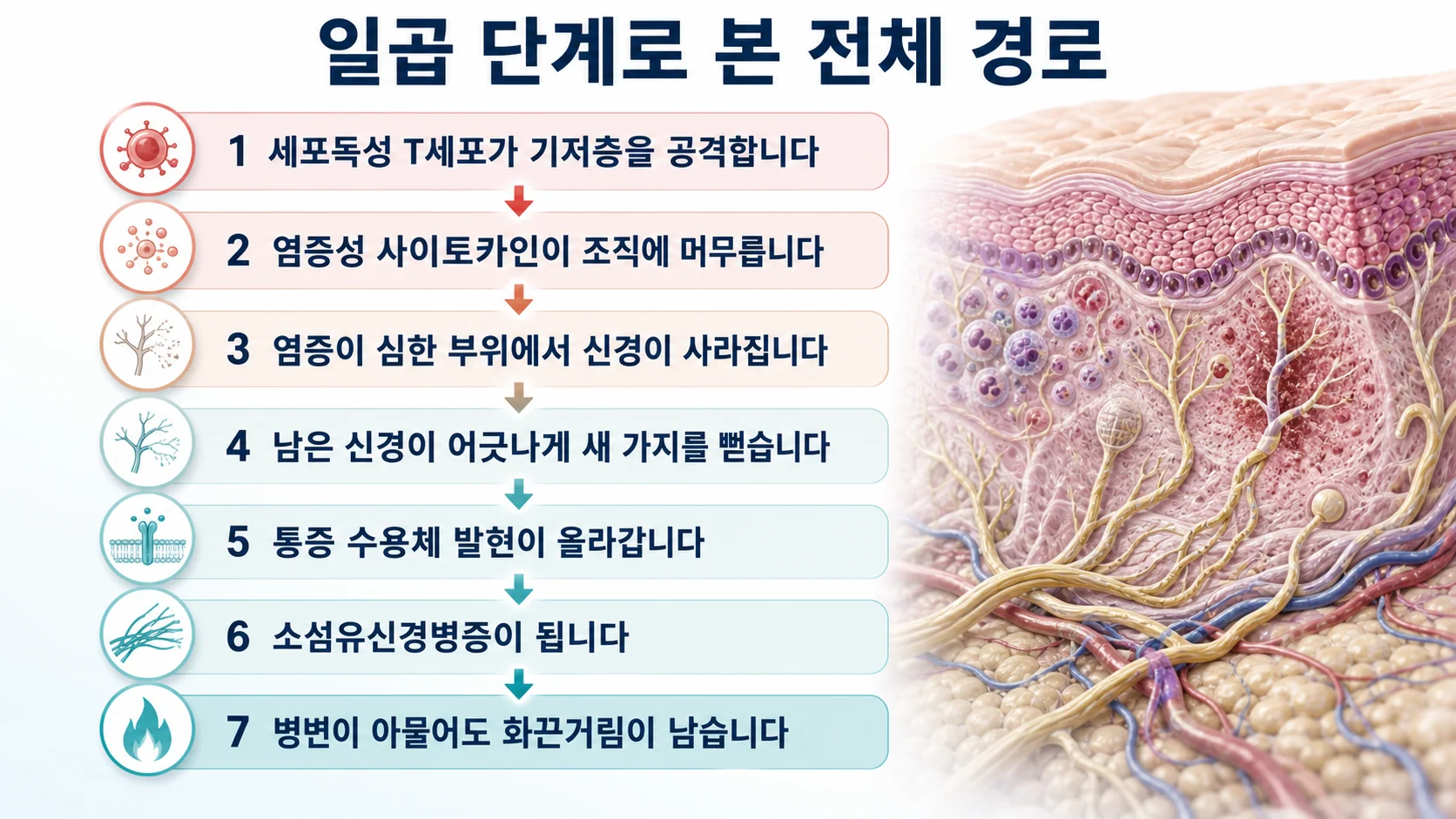 세포독성 T세포의 기저층 공격에서 시작해 사이토카인 축적과 신경 후퇴, 수용체 감작을 거쳐 병변이 나아도 화끈거림이 남는 일곱 단계를 순서대로 보여주는 그림