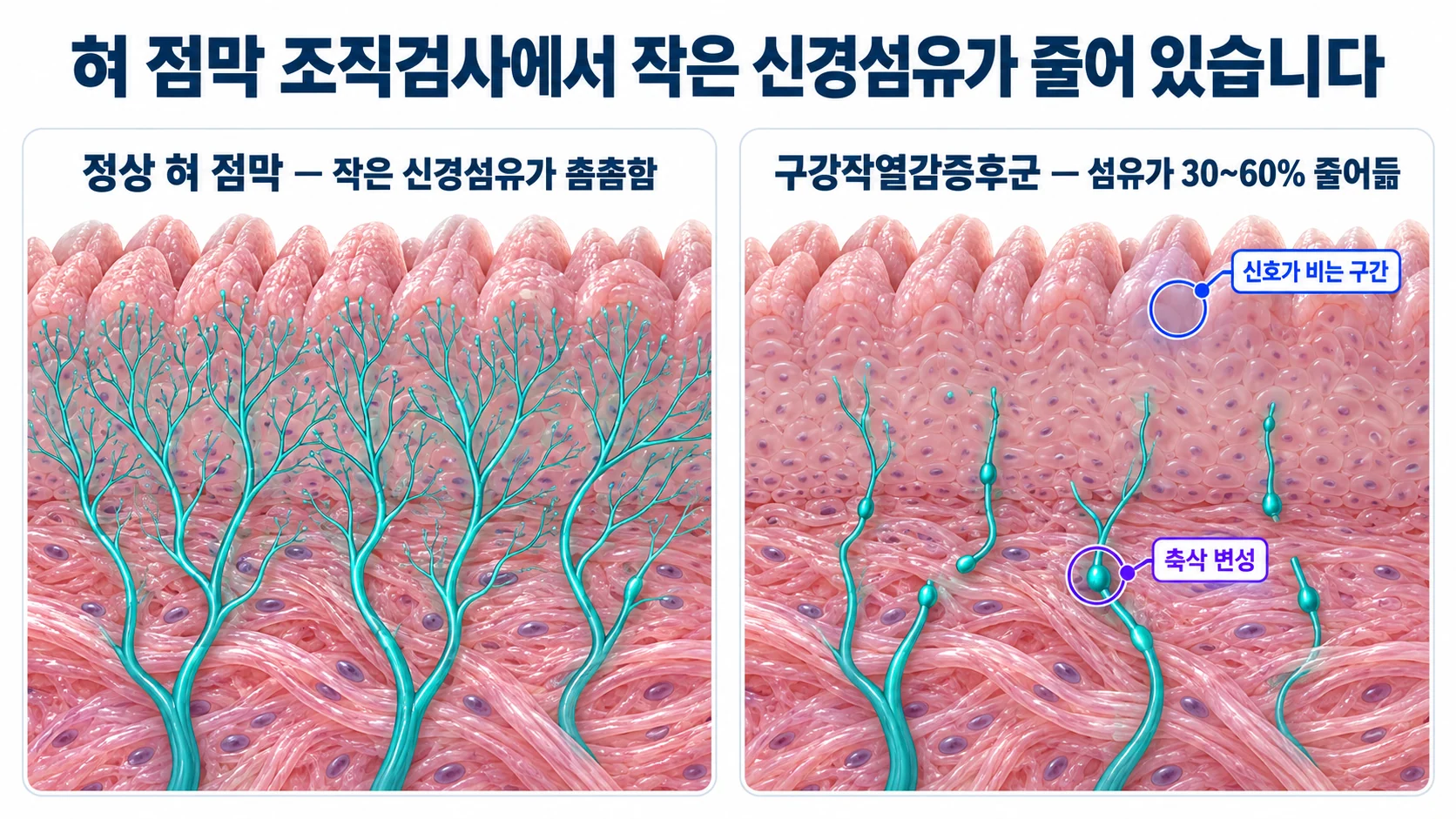 정상 혀 점막과 구강작열감증후군 혀 점막의 상피 내 신경섬유 밀도를 비교한 3D 단면 그림
