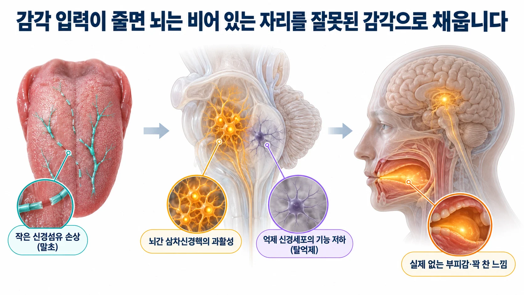 작은 신경섬유 손상이 뇌간의 탈억제를 거쳐 실제 없는 부피감과 꽉 찬 느낌으로 이어지는 과정을 보여 주는 3D 도식