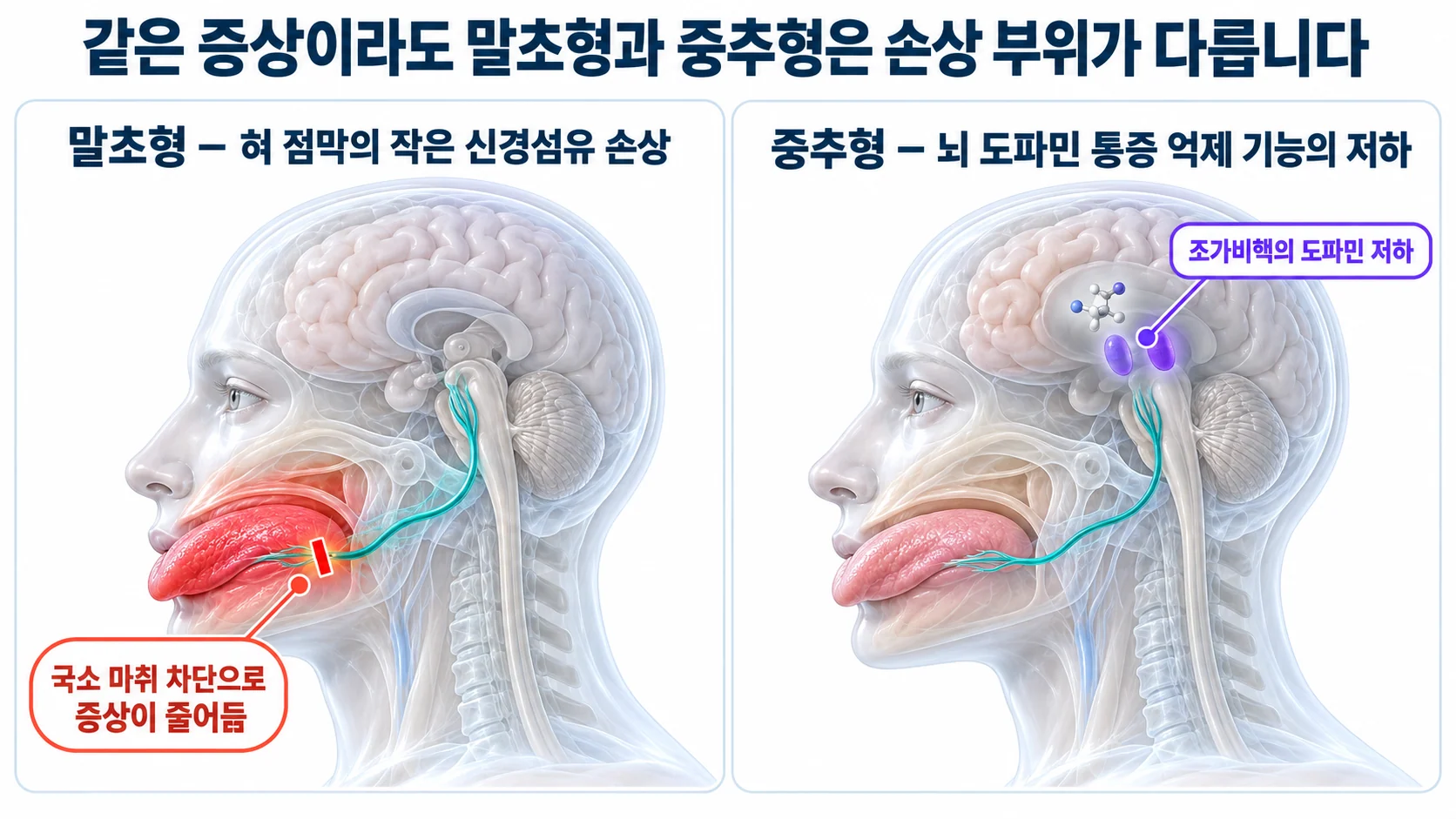 말초형과 중추형 신경병증의 손상 부위를 나란히 비교한 3D 그림