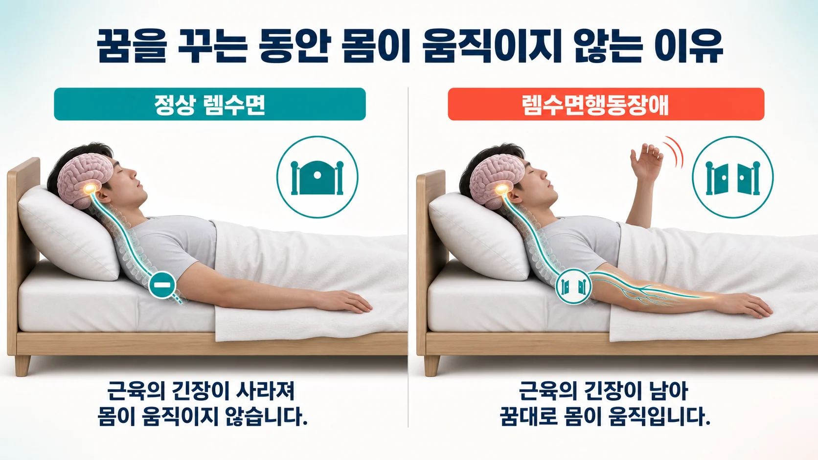 정상 렘수면에서는 근긴장이 사라지고 렘수면행동장애에서는 근긴장이 남아 꿈대로 몸이 움직이는 차이를 보여주는 도식