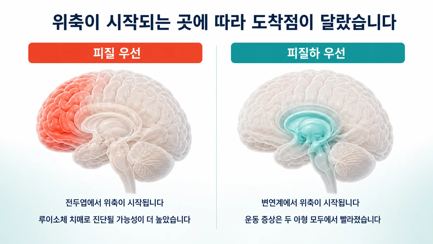 피질 우선 위축과 피질하 우선 위축이라는 두 갈래 진행 아형과 각각의 도착점을 나타낸 비교 도식
