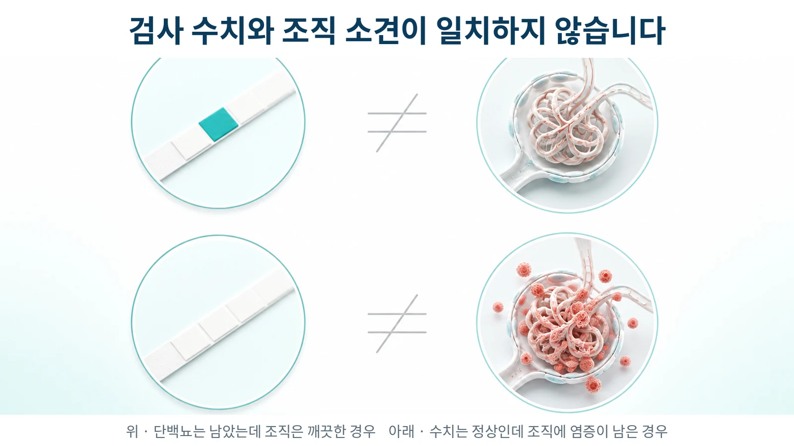 검사 수치와 조직 소견이 일치하지 않는 두 방향