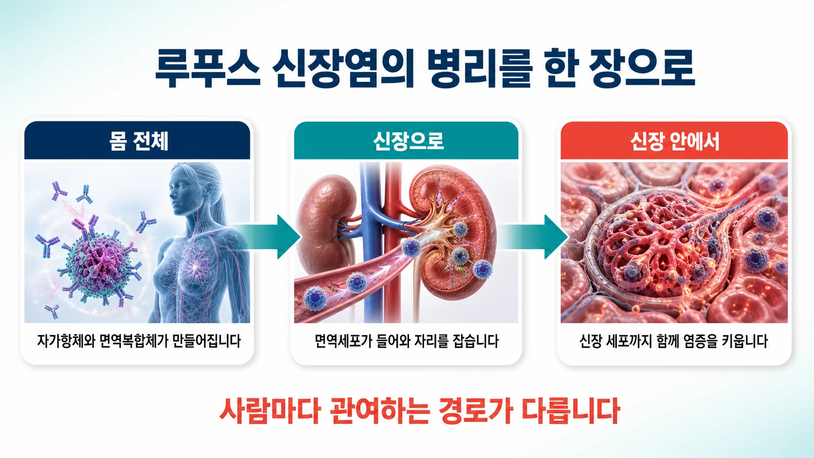 루푸스 신장염의 병리를 한 장으로 정리하면