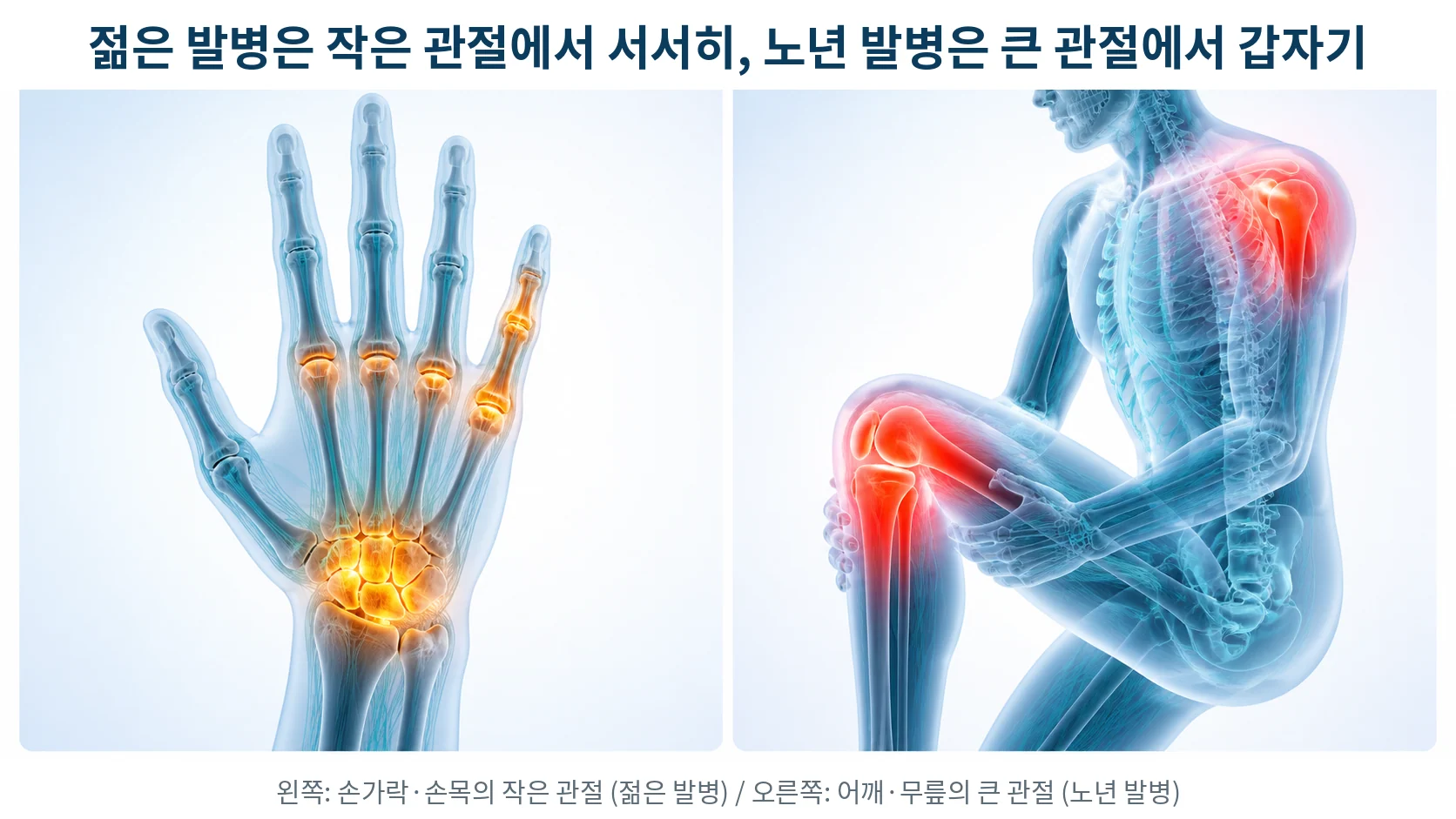 젊은 발병은 손가락·손목 같은 작은 관절에서, 노년 발병은 어깨·무릎 같은 큰 관절에서 시작하는 차이를 나란히 보여주는 3D 의료 일러스트