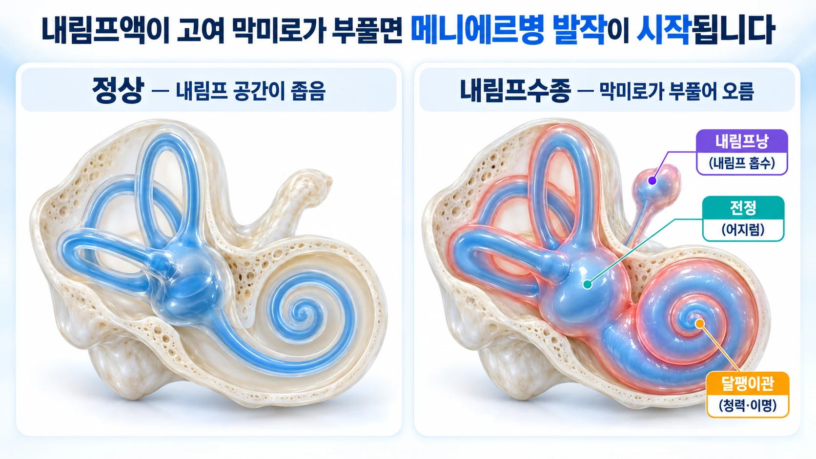 정상 속귀와 내림프수종 속귀를 나란히 비교해 부풀어 오른 막미로와 달팽이관·전정·내림프낭의 위치를 표시한 3D 그림
