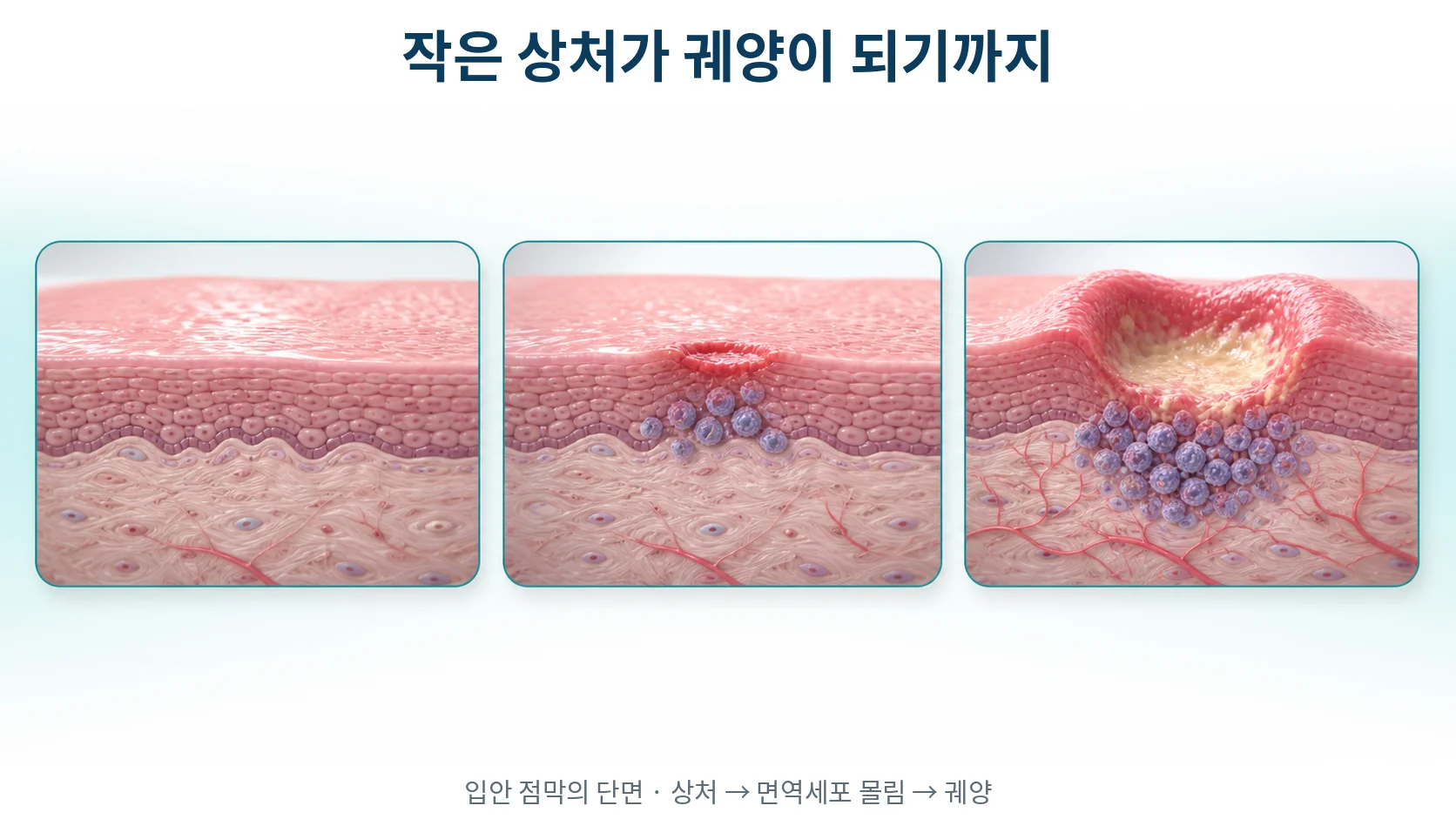 입안 점막의 작은 상처가 면역세포가 몰리면서 궤양으로 번지는 세 단계를 보여주는 단면 그림
