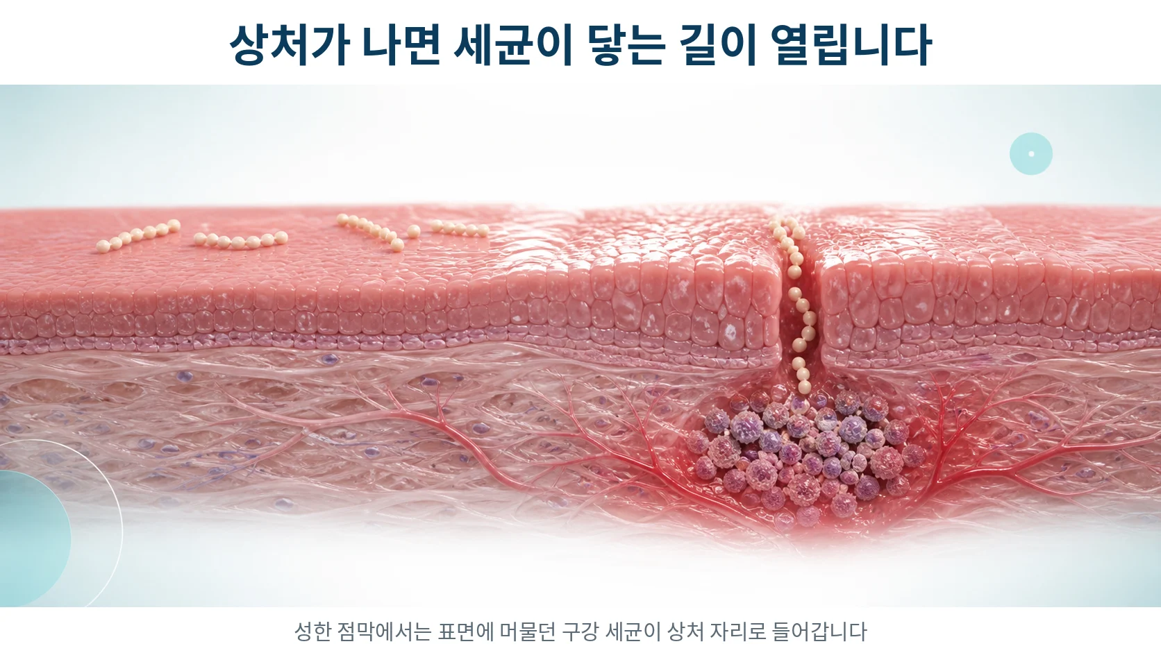 성한 점막에서는 표면에 머물던 구강 세균이 상처가 생긴 자리로 들어가 면역세포가 몰려드는 과정을 보여주는 단면 그림