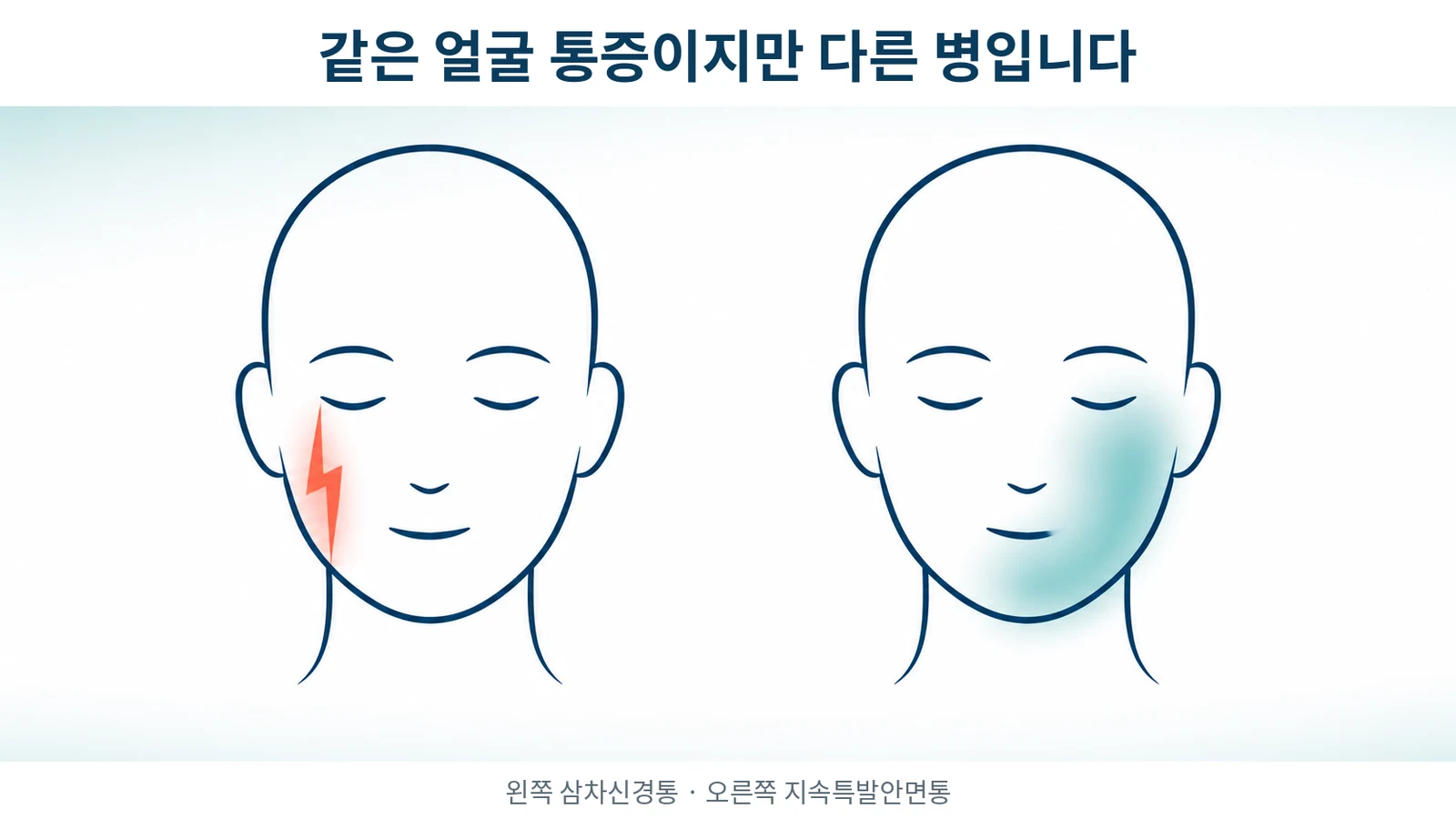 삼차신경통(trigeminal neuralgia, TN)과 지속특발안면통(persistent idiopathic facial pain, PIFP)의 비교