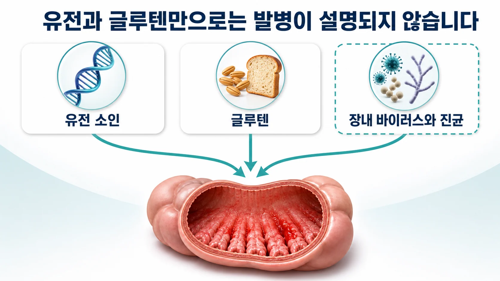 유전 소인과 글루텐 외에 장내 바이러스와 진균이 셀리악병의 추가 요인으로 제안된다는 개념 그림