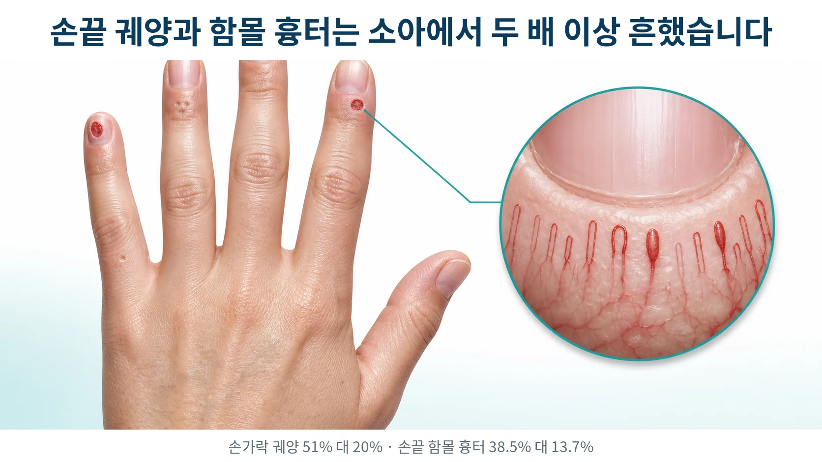 손가락 끝의 궤양과 작게 파인 흉터를 보여 주는 손 그림과 손톱 뿌리 부위 모세혈관을 확대한 원형 삽입 그림