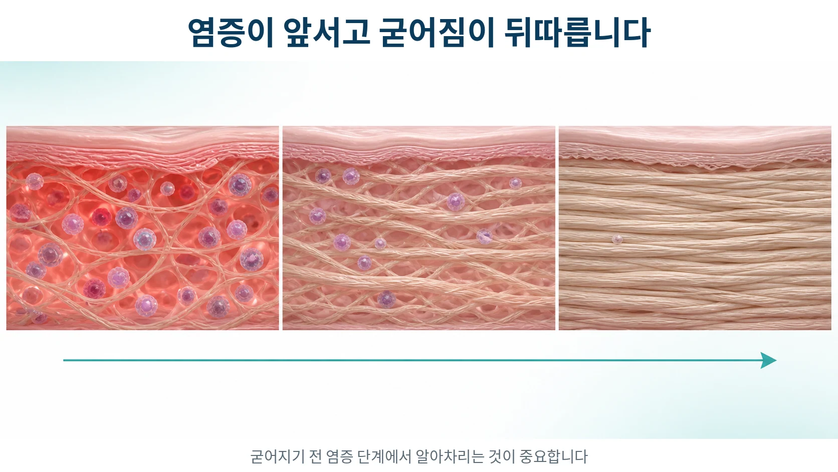 왼쪽에서 오른쪽으로 갈수록 염증이 줄고 아교질 섬유가 촘촘히 쌓여 조직이 굳어지는 과정을 단계적으로 보여 주는 그림