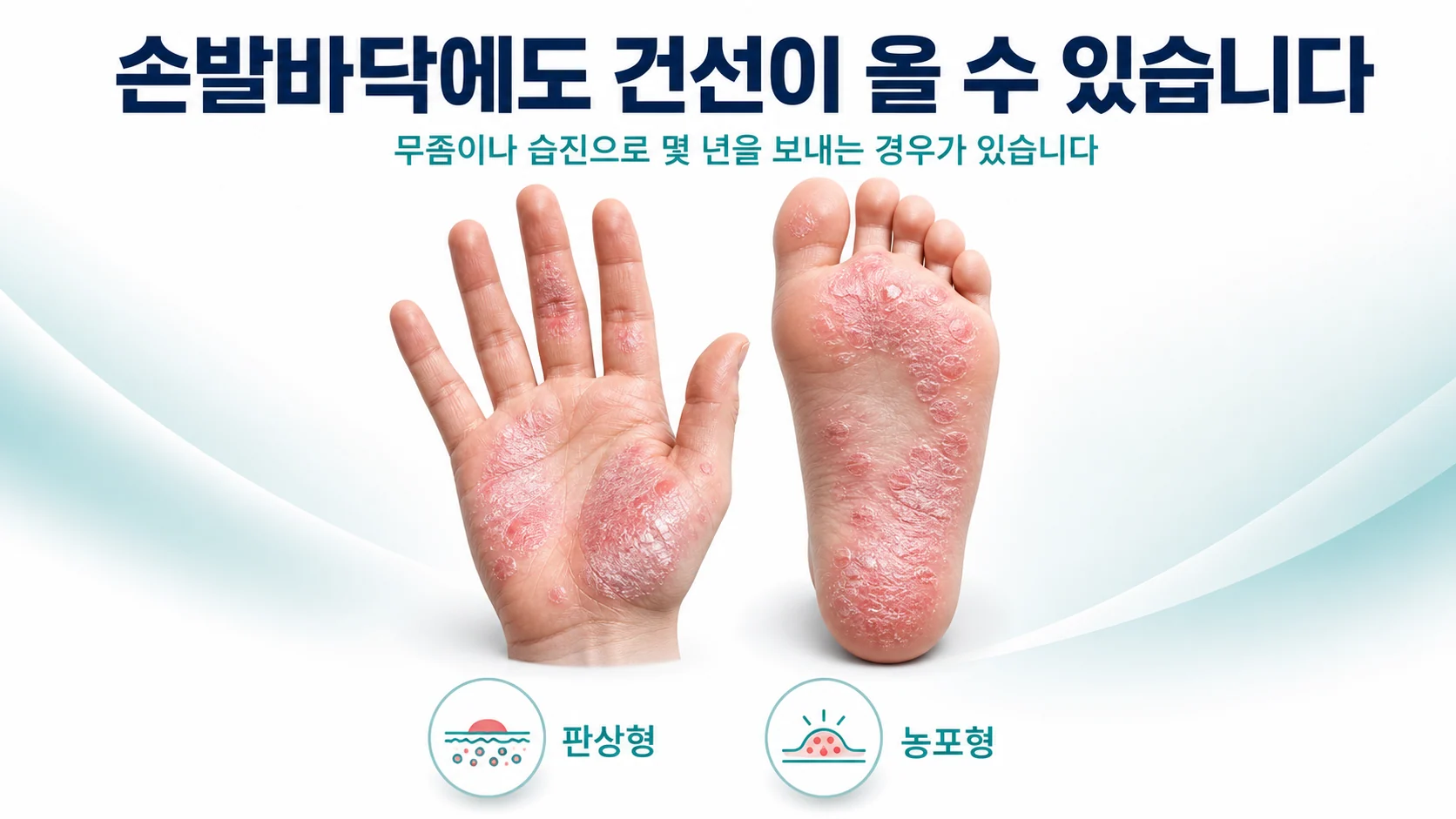손발바닥에도 건선이 생길 수 있다는 것을 설명하는 대표 이미지