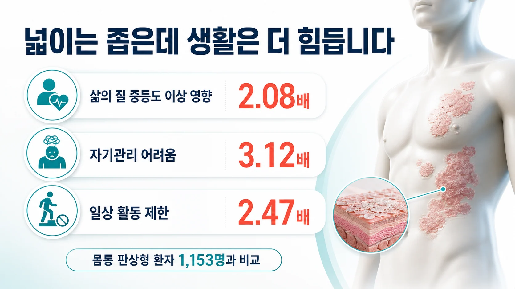 손발바닥 병변이 몸통 판상형보다 삶의 질을 더 크게 떨어뜨린다는 연구 결과를 보여 주는 도표