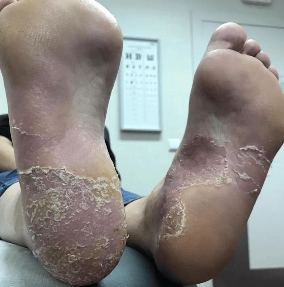 발바닥 병변 환자의 양쪽 발바닥 임상사진, 뒤꿈치와 발바닥 앞쪽에 두꺼운 각질과 인설이 보인다