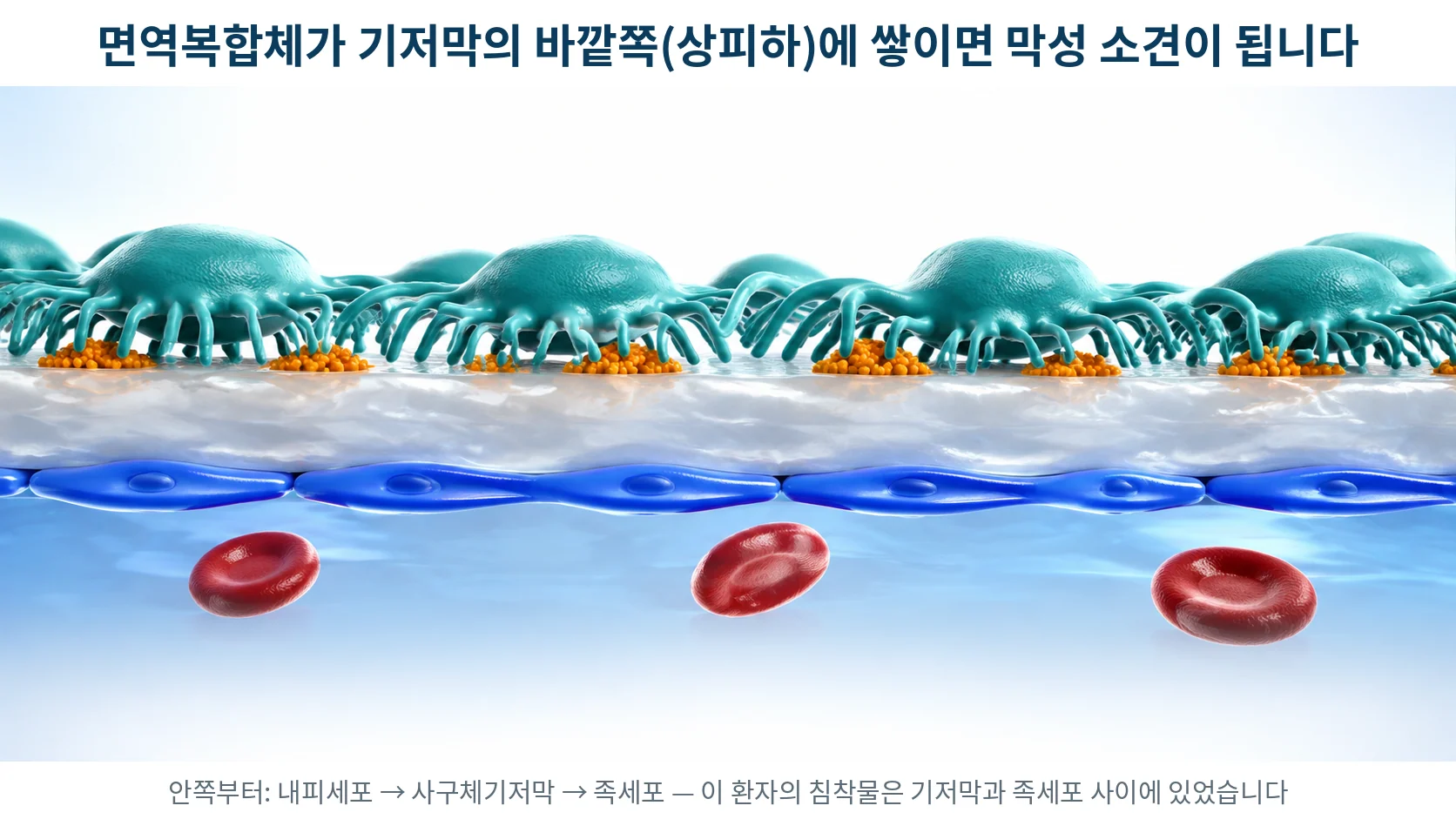 사구체 모세혈관벽 단면 — 내피세포·기저막·족세포 사이에 면역복합체가 쌓이는 위치를 보여주는 3D 의료 일러스트