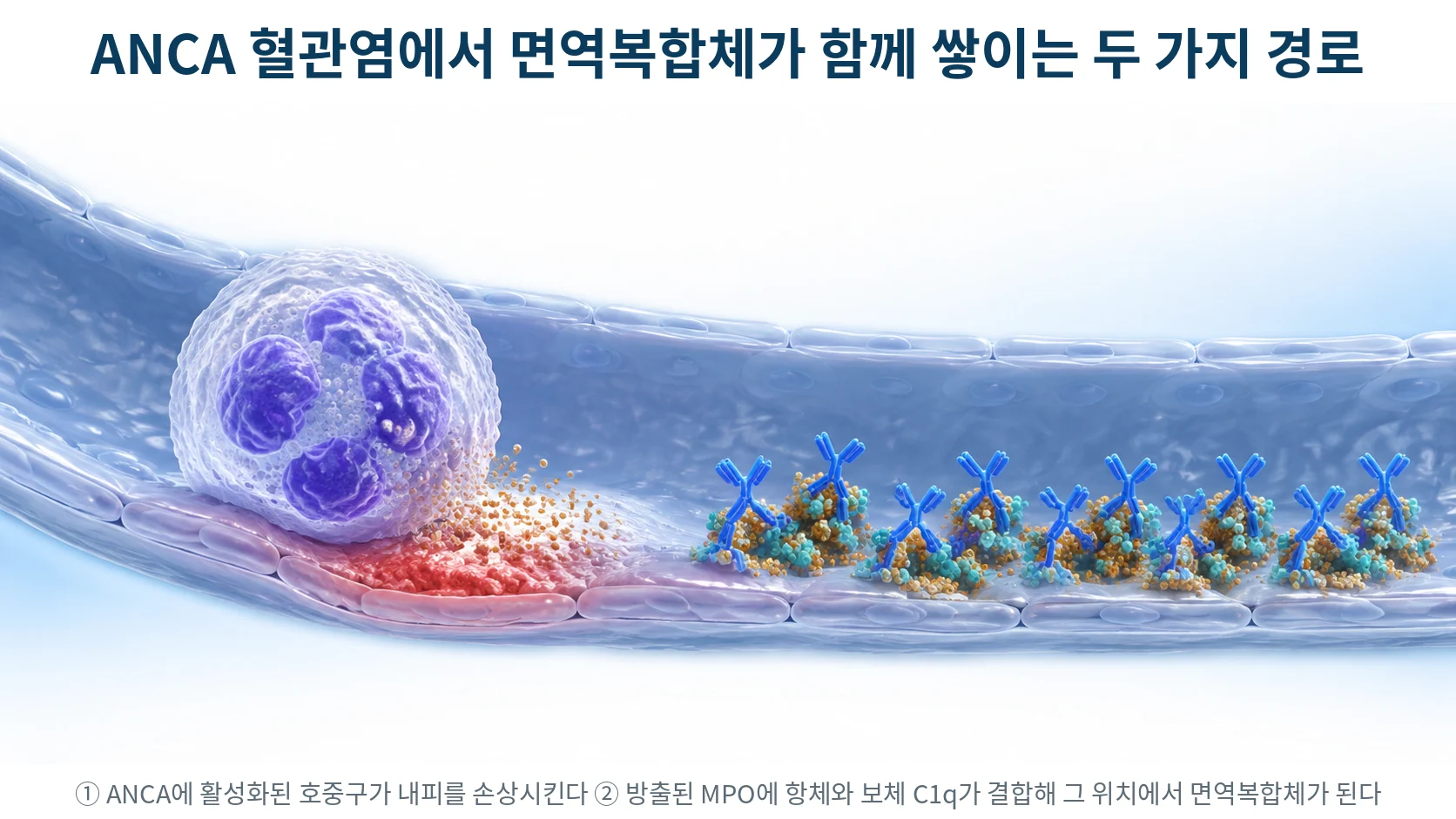 호중구가 방출한 MPO가 사구체 모세혈관 내피에 붙고, 그 위로 항체와 보체 C1q가 결합해 면역복합체가 형성되는 과정을 표현한 3D 의료 일러스트