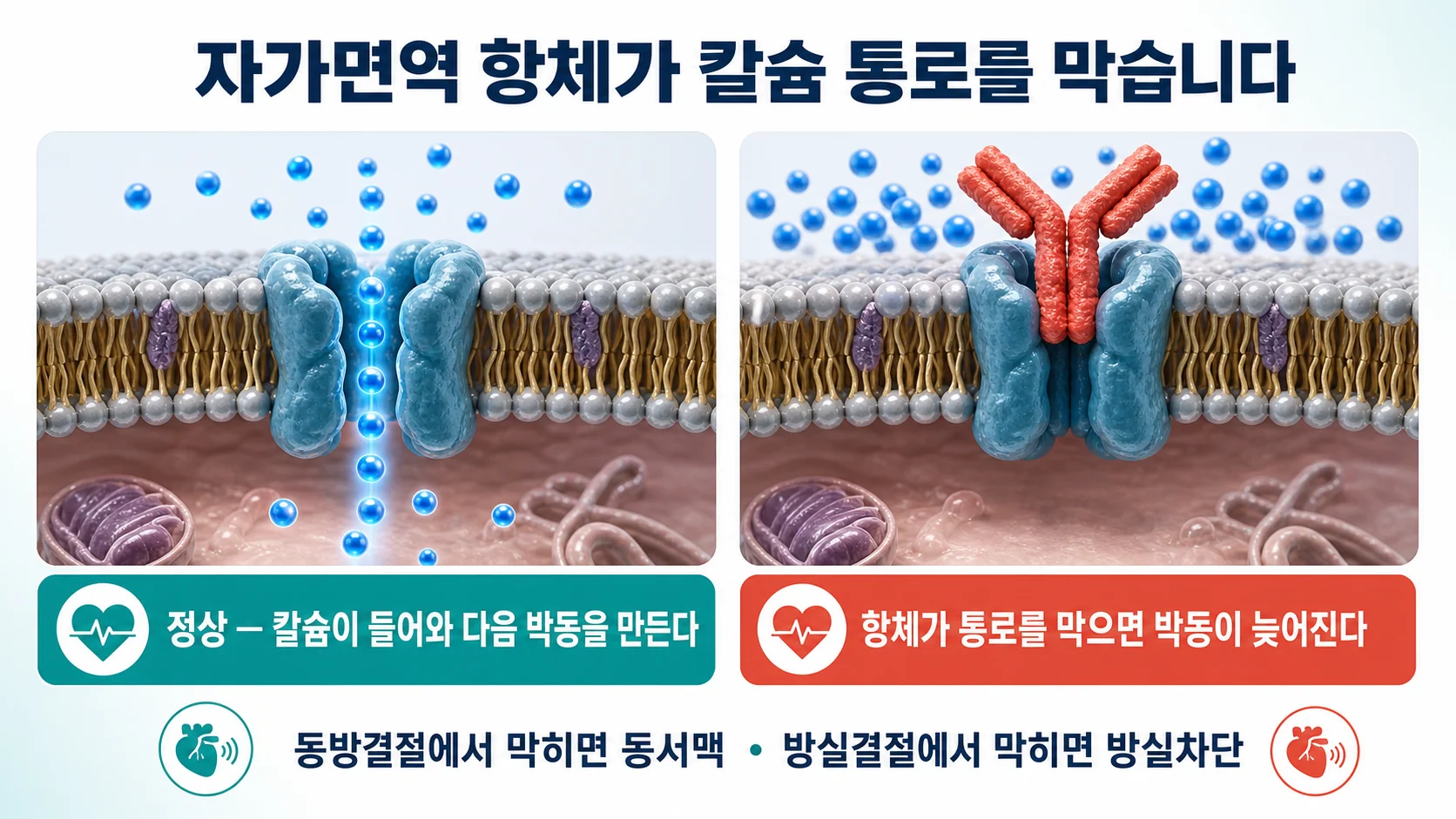 자가면역 항체가 심장 박동조율세포의 칼슘 통로를 막아 맥이 느려지는 기전을 설명하는 이미지