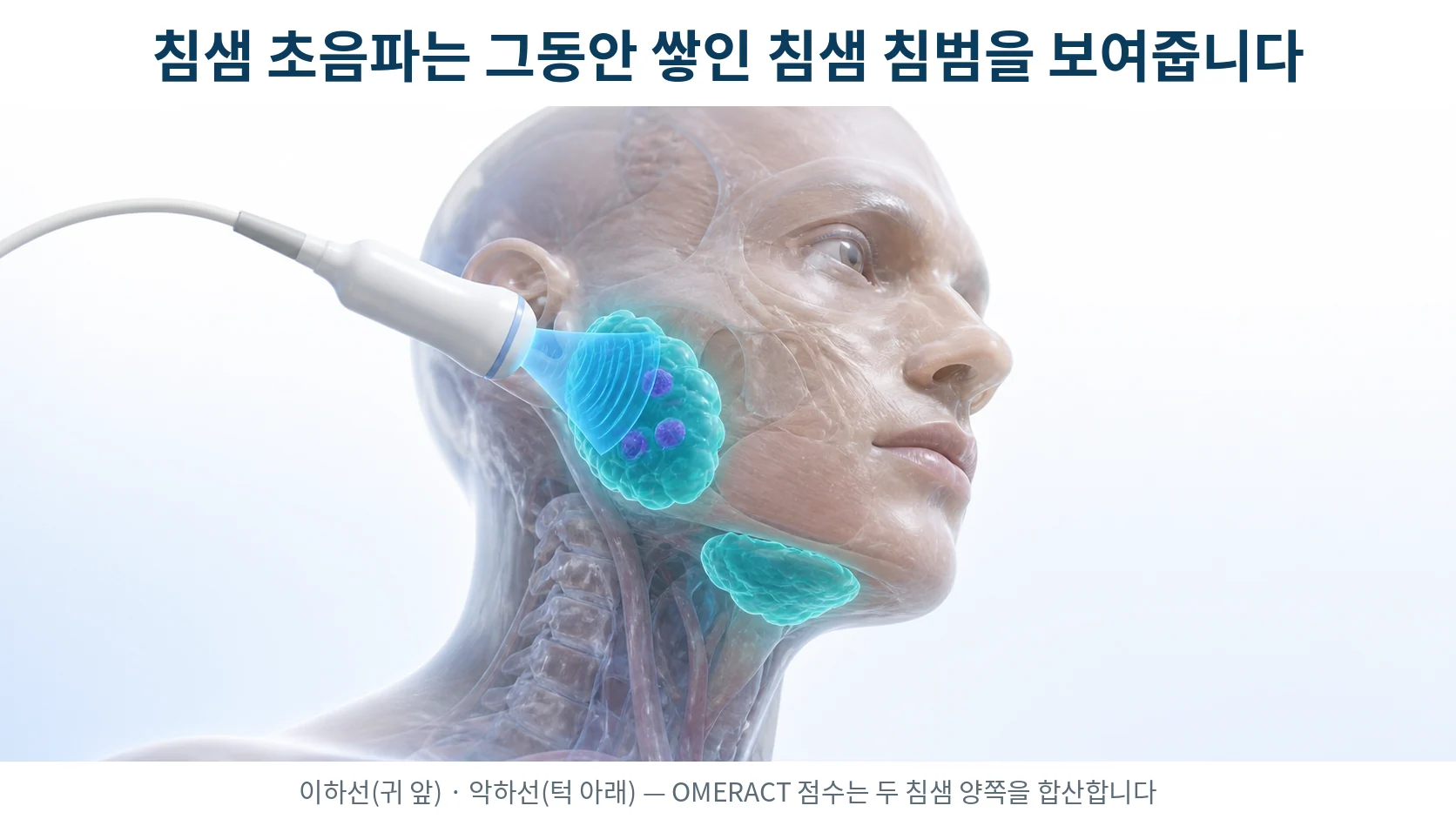 이하선과 악하선에 초음파 탐촉자를 대어 침샘 내부의 저에코 병소를 살피는 3D 의료 일러스트